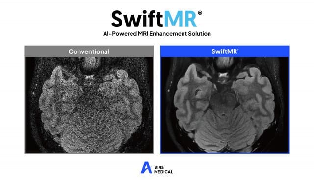 에어스메디컬, 서울대병원에 MRI AI솔루션 ‘스위프트엠알’ 공급